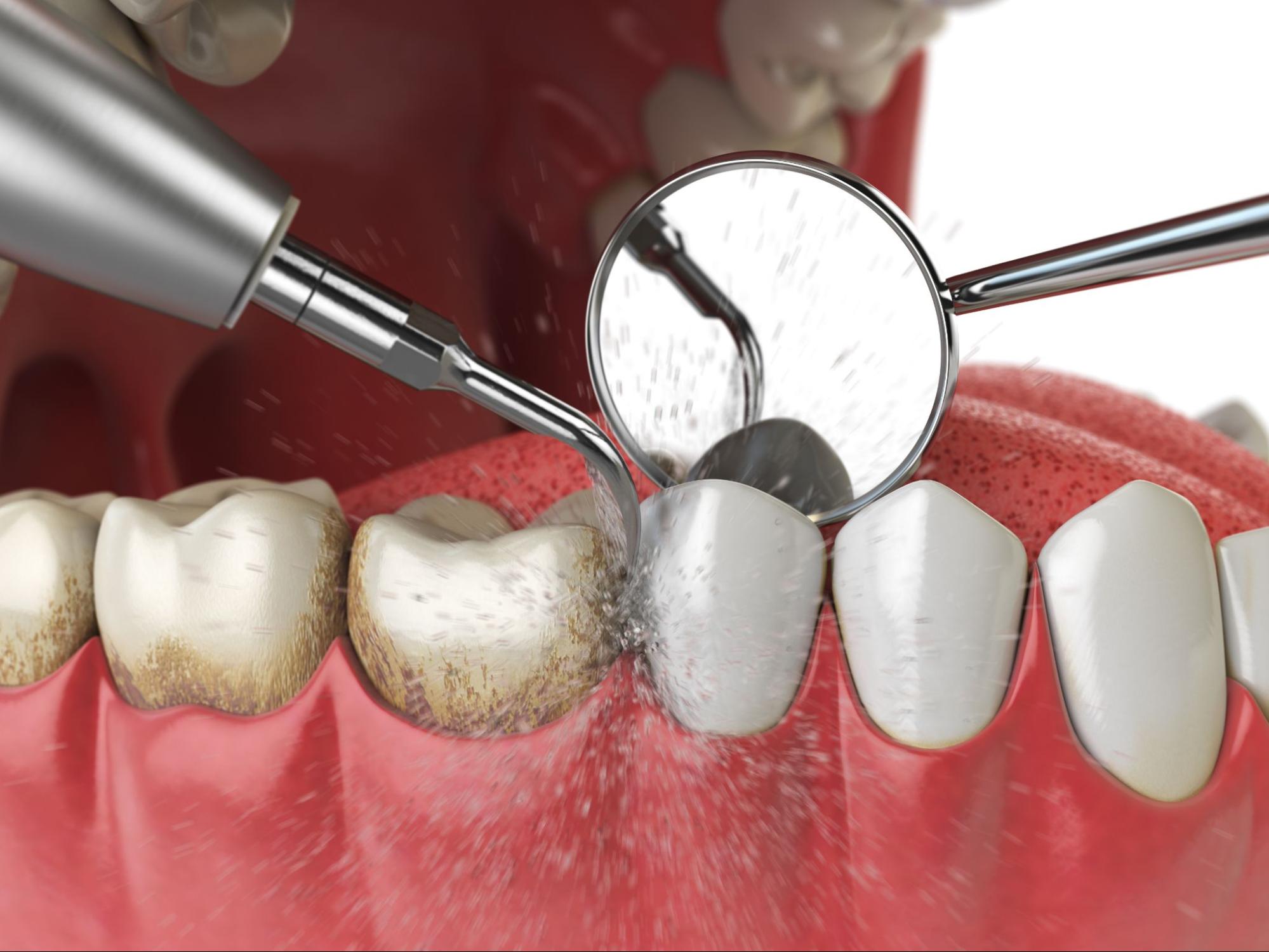 歯石除去は保険適用される？料金はいくら？自由診療との違いや効果を詳しく解説！
