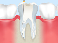 根管治療