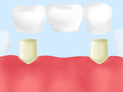 違和感を少なくする「ブリッジ」