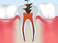 根管治療の流れ