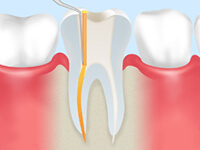 根管治療の流れ