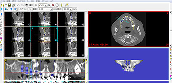 特徴③：歯科用CTを用いた安全な検査と施術