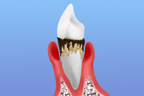 歯周病の症状と治療法