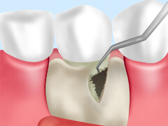 重度の歯周病